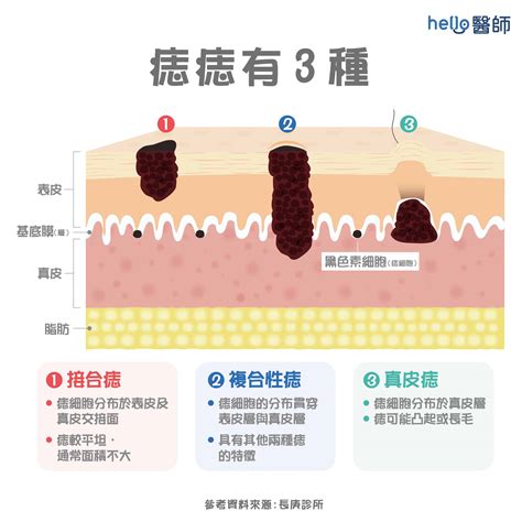 痣很凸|為什麼臉上的痣越來越多？皮膚科醫師解析長痣原因、。